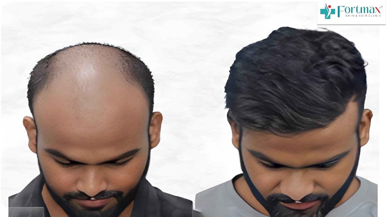 Male-hair-transplant
